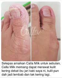 Apa kita perlu buat jika jari tersepit pintu kereta? Calla Bepretty Ibu Jari Kaki Kulitnya Kering Dan Tak