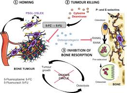 Cancer in the bone may cause severe pain for a while before the bone breaks. Combinatorial Targeting Of Cancer Bone Metastasis Using Mrna Engineered Stem Cells Ebiomedicine