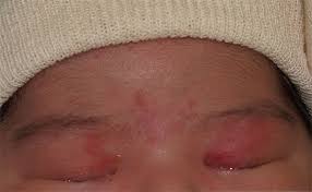 Image result for Nevus Simplex