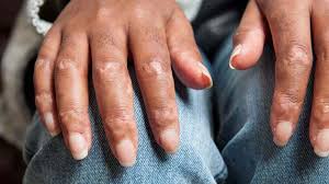 Image result for Scleroderma geaster