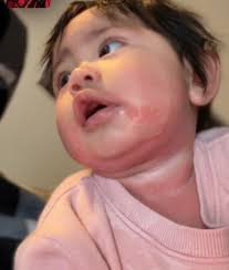 Drool rash? Wondering what's best to clear this suspected drool rash around  my 10 month olds mouth? She doesn't appear bothered by it but it looks a  bit sore. Terrible photos as