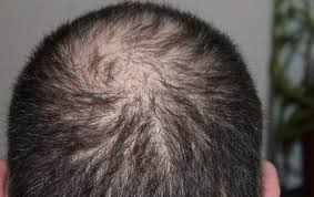 In this review, we are going to look at those treatments that are backed by evidence and discuss how they work so that you can make the best choice to treat your receding hairline. 10 Best Hair Loss Shampoo For Men 2018