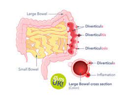 Diverticular Disease Diverticulitis Causes Symptoms Guts Uk