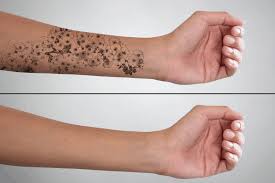 Tattoo removal is now a reality for many people who thought they were stuck with ugly ink on their bodies forever. Laser Tattoo Removal Chesapeake Dermacare Of Hampton Roads 757 317 3744