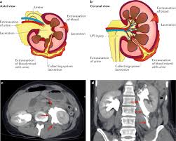 The majority of parenchymal cystic lesions represent benign epithelial cysts; Diagnosis And Management Of Urinary Extravasation After High Grade Renal Trauma Nature Reviews Urology