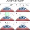 It is similar to other corrective procedures such as eye drops that numb the surface of the eye is used as the anesthetic, and the procedure is done in the awake state. 1
