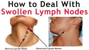 The lymph nodes filter lymph fluid as it flows through them, trapping bacteria, viruses, and other foreign substances, which are then destroyed by special white blood cells the glands on either side of the neck, under the jaw, or behind the ears commonly swell when you have a cold or sore throat. Swollen Glands Or Lymph Nodes With Fibromyalgia Me Cfs Fibromyalgia Resources