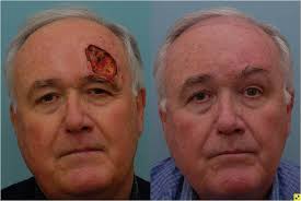 Mohs surgery is a commonly performed procedure that involves removing cancer from the skin. Mohs Surgery And Skin Cancer Johns Hopkins Facial Plastic And Reconstructive Surgery