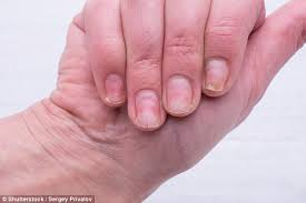 Get rid of painful cracked nails! Nail Expert Shares The Best Way To Repair Damaged Nails At Home Daily Mail Online