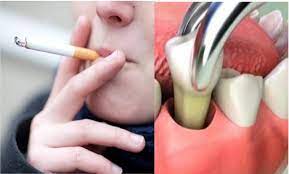 Cigarette smoking causes most cases of lung cancer.1,2 if you have asthma, tobacco smoke can trigger an attack or make an attack worse.1,2 When Can I Smoke After Tooth Extraction Public Health