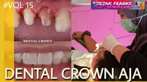 Bridge gigi biasanya digunakan untuk menggantikan gigi asli yang mengalami kerusakan lebih dari satu gigi. Review Cara Pasang Gigi Crown Atau Gigi Metal Porselen Di Dokter Olivia Bsd Tanggerang Youtube