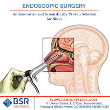 Balloon Sinuplasty Or Sinus Ostial Dilation Surgery Is A Newer Method To Address Sinus Disease It Expands The Natural Dr Sinusitis Sinus Surgery Sinus Disease
