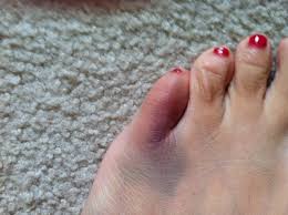 Parmak Kirigi Kac Gunde Iyilesir Tedavisi Ve Iyilesme Sureci