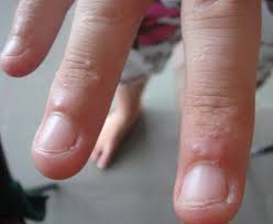 Image result for dyshidrosis