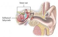 Image result for Bacterial Labyrinthitis