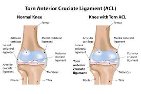 Each ace in an acl identifies a trustee and specifies the access rights allowed, denied, or audited for that trustee. Anterior Cruciate Ligament Acl Tear Injury Mount Elizabeth Hospitals