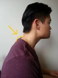 I see this especially with people who have forward head posture. How To Get Rid Of A Dowager S Hump Posture Direct