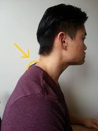 The medical description for neck hump is dowager. How To Get Rid Of A Dowager S Hump Posture Direct