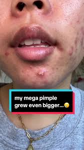 Choosing the Right Pimple Patch for My Growing Mega Pimple