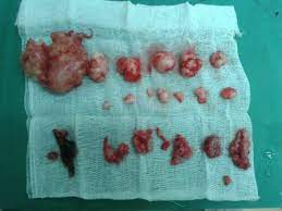We did not find results for: 16 Makanan Yang Perlu Diambil Oleh Wanita Supaya Tidak Terjadi Ketumbuhan Fibroid Dan Sakit Dalaman Kartel Dakwah