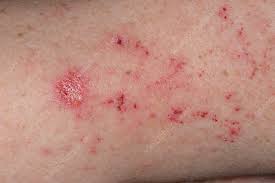 Image result for scabies on human skin