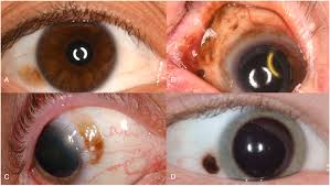 Image result for conjunctival melanoma