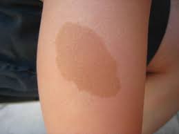 Some do come out more when you have been in the sun. Cafe Au Lait Spots Causes Symptoms Diagnosis Treatment Prognosis