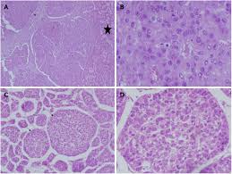 The health care team will watch you for signs of bleeding, infection, liver. Pediatric Hepatocellular Carcinoma