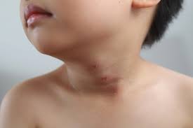 Valentinus nahak melawan kanker kelenjar. Kelenjar Getah Bening Bengkak Pada Anak Ini Penyebabnya Honestdocs