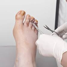 Image result for Hammer toe