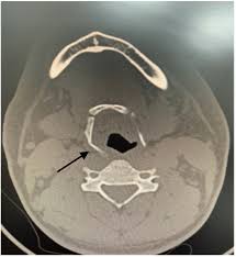 Image result for Hyoid Bone