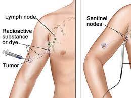 In some rare cases, swollen lymph nodes can be a symptom of cancer in the lymph nodes themselves or in other parts of the body. Lymph Node Surgery In Melanoma National Cancer Institute