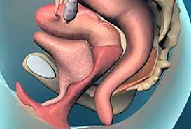 If surgery is needed, it has a high success rate and. Can You Fix Prolapse Without Surgery