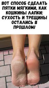 боль в пятке при ходьбе как лечить в домашних условиях Sovety I Recepty Zdorove Tovary Dlya Zdorovya I Dieta Dlya Ploskogo Zhivota