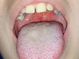 Exista diferente internationale referitor la testarea pentru prezenta streptococului beta. Revenind La Streptococul Spitalul Virtual Pentru Copii Facebook