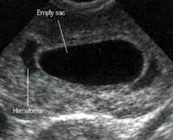 The only benefit of waiting is that there are no chances of complications arising from surgery or medicines. Blighted Ovum And Missed Miscarriage Wehavekids
