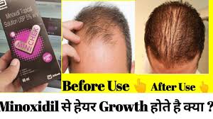 Hair oils aren't just for dry hair that's thick or curly. Mx 2 Mx 5 Solution Complete Review à¤• à¤¯ à¤¹ à¤¤ à¤¹ Minoxidil à¤²à¤— à¤¨ à¤¸ à¤• à¤¯ Hair Growth à¤¹ à¤¤ à¤¹ Youtube