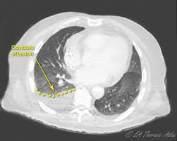 Image result for Parapneumonic Effusion