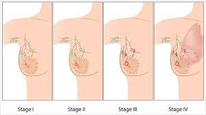 Doctors who specialize in examining thermography images will be able to identify whether or not angiogenesis is taking a lot of health experts like to talk about breast cancer as something that results from bad genetics, being. Breast Cancer On Customer Support Knowledge Base