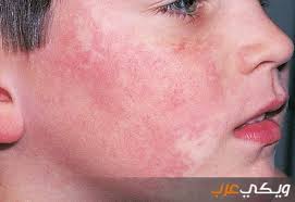 الأمراض العصبية مرض الصرع, اسبابه, وطرق علاجه 18 أغسطس 2011. Ø§Ø¹Ø±Ø§Ø¶ Ù…Ø±Ø¶ Ø§Ù„Ø°Ø¦Ø¨Ø© Ø§Ù„Ø­Ù…Ø±Ø§Ø¡ ÙˆÙŠÙƒÙŠ Ø¹Ø±Ø¨