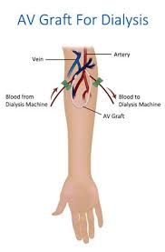 Pin On Av Fistula Surgery Spring Hill Florida