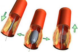 Resultado de imagen de arterioesclerosis y ateroesclerosis