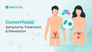 Image result for gonorrhea symptoms