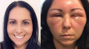 Of these, as many as 38% will report itchiness or localized reactions to the hair dye products. Woman S Allergic Reaction To Hair Dye Causes Severe Swelling In Face Head Fox 46 Charlotte