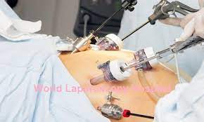 Does insurance cover laparoscopy in india. Institute Of Advanced Laparoscopic And Robotic Surgery