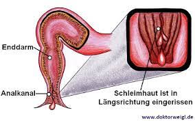 Der hausarzt wird sie gegebenenfalls an einen proktologen überweisen. Doktorweigl Erklart Was Macht Ein Proktologe Aufgaben Krankheitsbilder