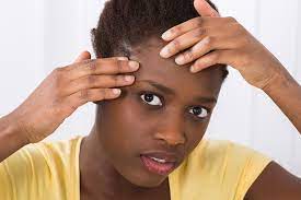 How do i get rid of hormonal acne? How To Get Rid Of Hairline Acne Buckhead Dermatology