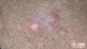 Image result for folliculitis symptoms