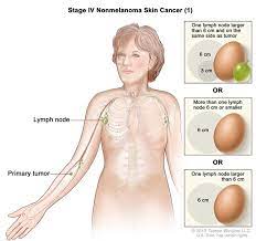 Pain and fractures, when cancer has spread to the bone headache, seizures, or dizziness, when cancer has spread to the brain shortness of breath, when cancer has spread to the lung Cancerhelp Online Nci Cancer Diagnosis And Treatment