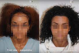 Frauen haben normalerweise eine andere art von haarausfall als männer. Haartransplantation Frauen So Funktioniert S Hairforlife